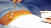 Bruststraffung mit Einlage von Implantaten Düsseldorf